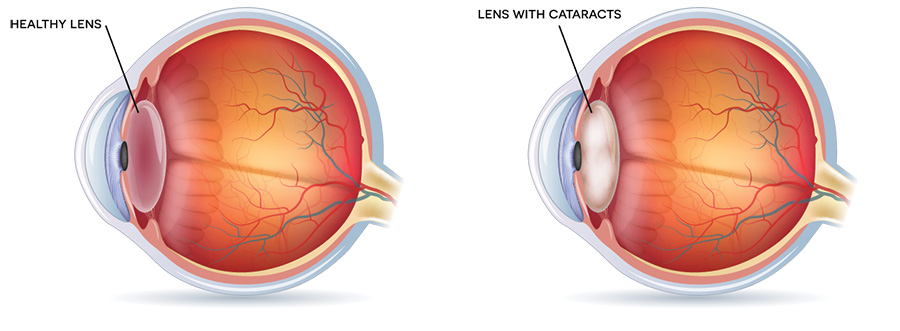 Chart Illustrating a Healthy Lens vs Lens With a Cataract