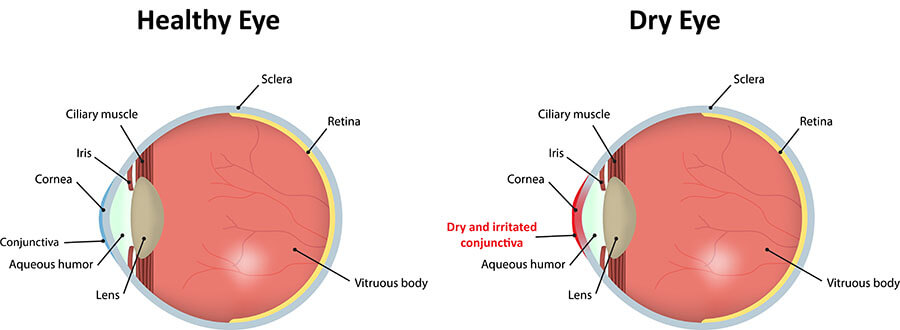 Chart Illustrating a Healthy Eye vs One Experiencing Dry Eye